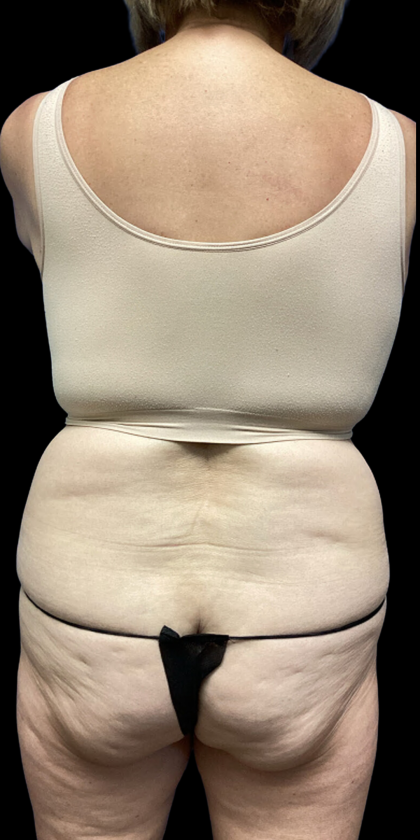 Tummy Tuck Before & After Patient #4622