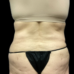Tummy Tuck Before & After Patient #4622