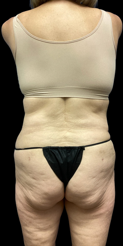 Tummy Tuck Before & After Patient #4622