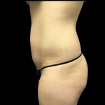 Tummy Tuck Before & After Patient #4556
