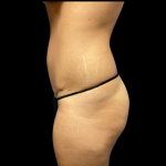 Tummy Tuck Before & After Patient #4556