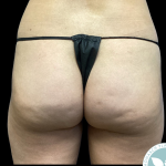 Aveli Before & After Patient #4558