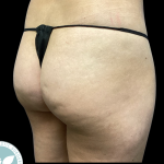 Aveli Before & After Patient #4558