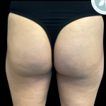 Aveli Before & After Patient #4558