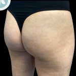 Aveli Before & After Patient #4558