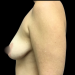 Breast Augmentation Before & After Patient #4661