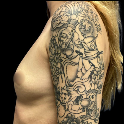 Breast Augmentation Before & After Patient #4560