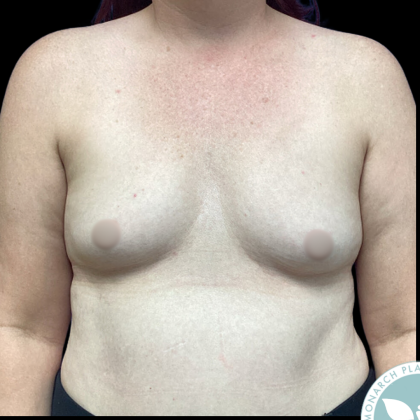 Breast Augmentation Before & After Patient #4561