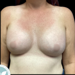 Breast Augmentation Before & After Patient #4561