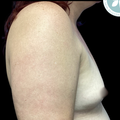Breast Augmentation Before & After Patient #4561