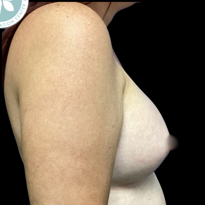 Breast Augmentation Before & After Patient #4561