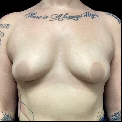 Breast Augmentation Before & After Patient #4662
