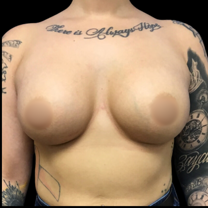 Breast Augmentation Before & After Patient #4662