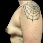 Breast Augmentation Before & After Patient #4662