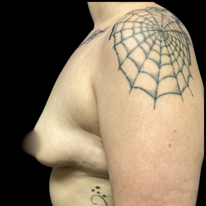 Breast Augmentation Before & After Patient #4662