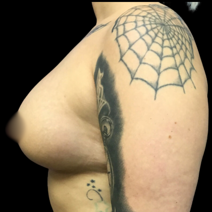 Breast Augmentation Before & After Patient #4662