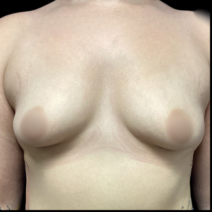 Breast Augmentation Before & After Patient #4564