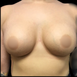 Breast Augmentation Before & After Patient #4564