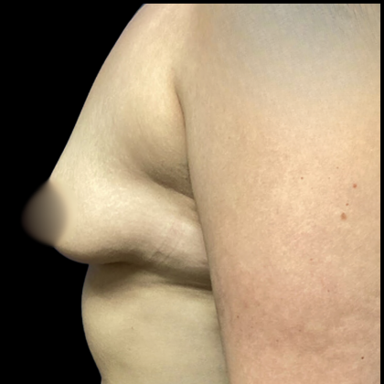 Breast Augmentation Before & After Patient #4564