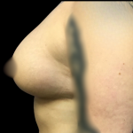 Breast Augmentation Before & After Patient #4564