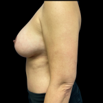 Breast Augmentation Before & After Patient #4578