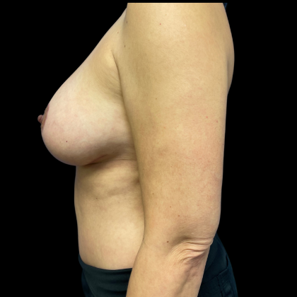 Breast Augmentation Before & After Patient #4578