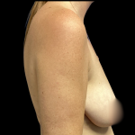 Breast Augmentation Before & After Patient #4566
