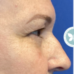 Blepharoplasty Before & After Patient #4625