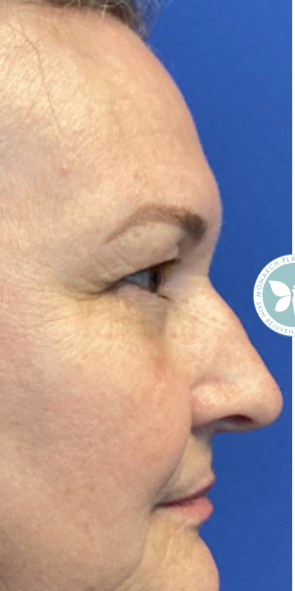 Blepharoplasty Before & After Patient #4625