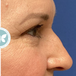Blepharoplasty Before & After Patient #4625
