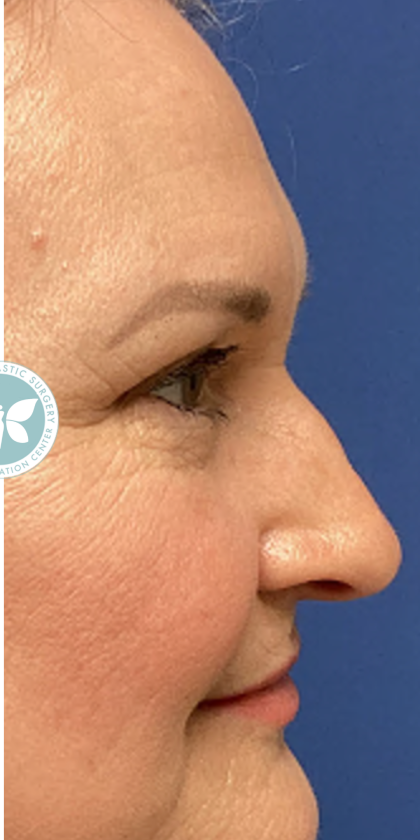 Blepharoplasty Before & After Patient #4625