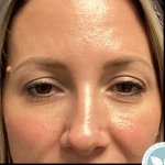 Blepharoplasty Before & After Patient #4567