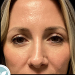 Blepharoplasty Before & After Patient #4567