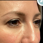 Blepharoplasty Before & After Patient #4567