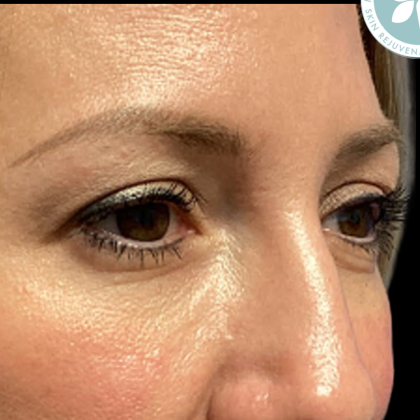 Blepharoplasty Before & After Patient #4567
