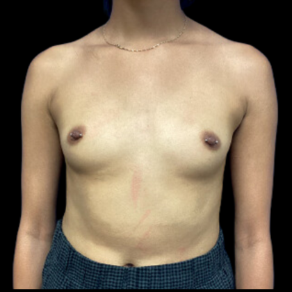 Breast Augmentation Before & After Patient #4664