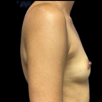 Breast Augmentation Before & After Patient #4664