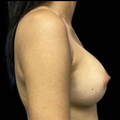 Breast Augmentation Before & After Patient #4664