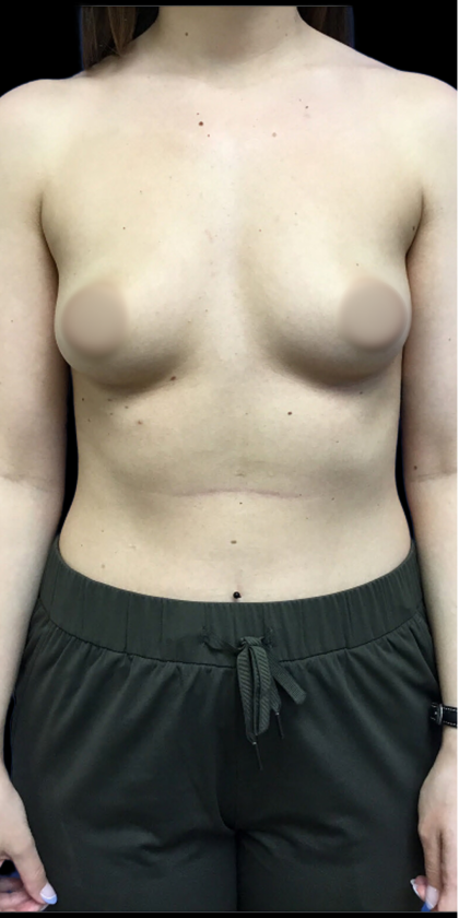 Breast Augmentation Before & After Patient #4624