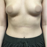 Breast Augmentation Before & After Patient #4665
