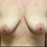 Breast Lift Before & After Patient #4627