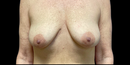 Breast Lift Before & After Patient #4627