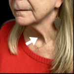 Neck Lift Before & After Patient #4568