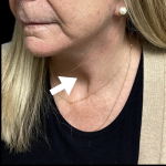 Neck Lift Before & After Patient #4568
