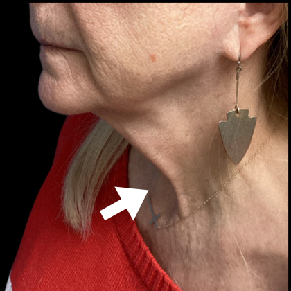 Neck Lift Before & After Patient #4568