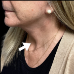 Neck Lift Before & After Patient #4568
