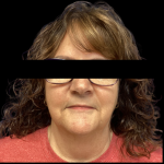 Facelift Before & After Patient #4569