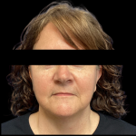Facelift Before & After Patient #4569
