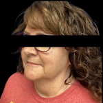 Facelift Before & After Patient #4569