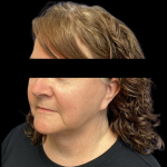Facelift Before & After Patient #4569